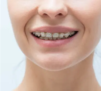 Know More About Invisible Braces / Clear Teeth Aligners Treatment