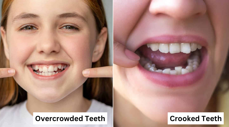 Crooked teeth can affect your smile and confidence while making oral hygiene challenging.