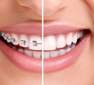 Do's And Don'ts of Eating With Invisible Braces/Clear Aligners