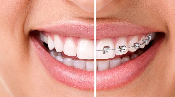 A smiling tooth of a person after undergoing treatment for overcrowded teeth with braces or aligners